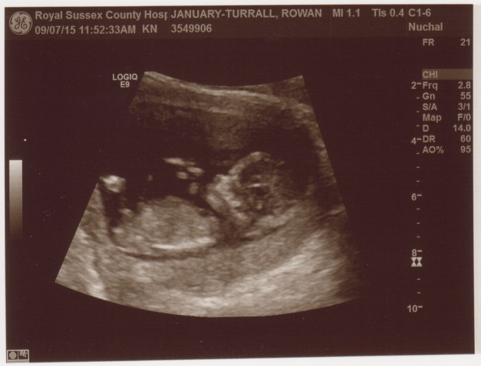 First scan of our baby